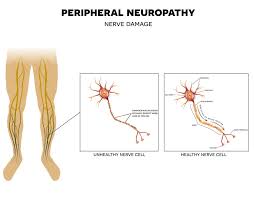 Neuropathy Treatment
